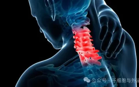 新案例：间充质干细胞治疗脊髓损伤患者20例，取得了积极结果