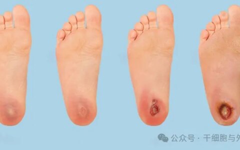 新报告60例：外泌体治疗糖尿病足溃疡创面效果显著