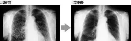 一个NK细胞能消灭27个癌细胞！人体内NK细胞的数量和活性，是健康的重要保障！