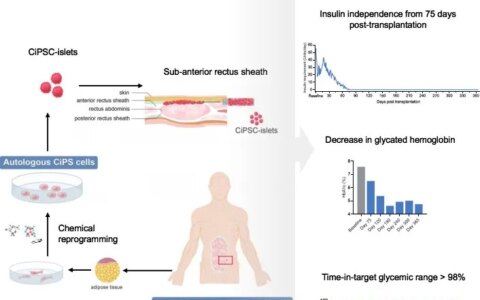 世界首例！中国团队用干细胞疗法治愈1型糖尿病！