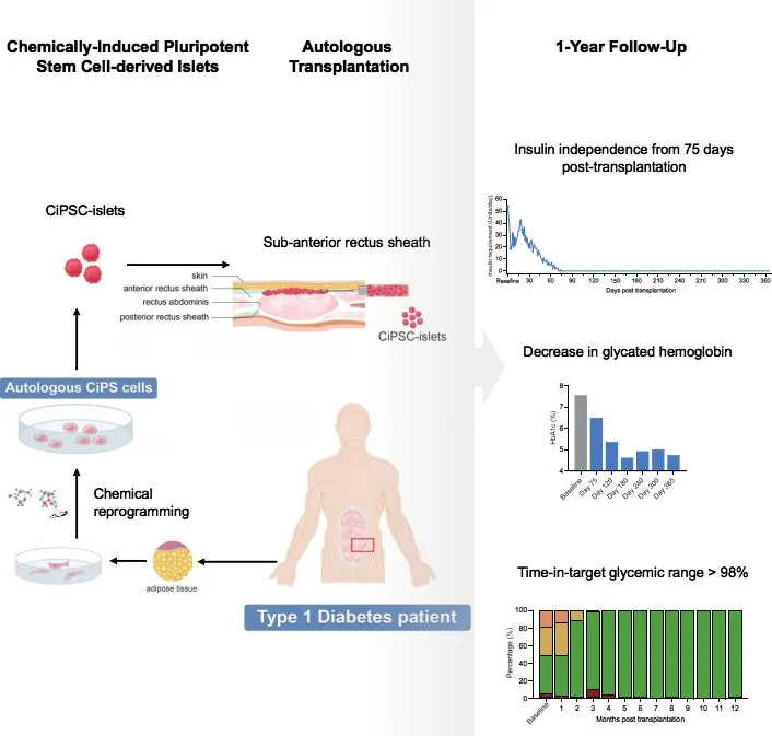 世界首例！中国团队用干细胞疗法治愈1型糖尿病！